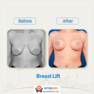 breast surgery before after12