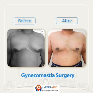 breast surgery before after13