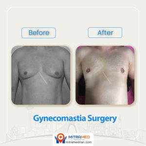 breast surgery before after14