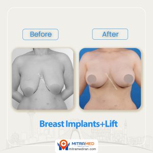 breast surgery before after15