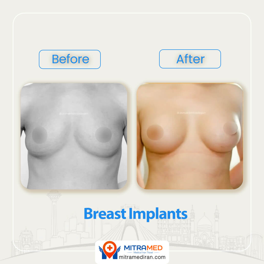 breast surgery before after2