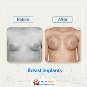 breast surgery before after3