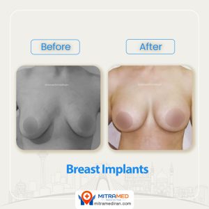 breast surgery before after4