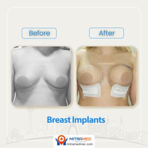 breast surgery before after5