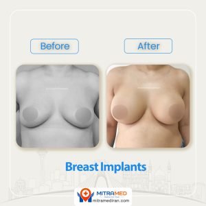 breast surgery before after6