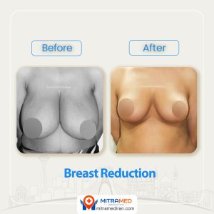 breast surgery before after9