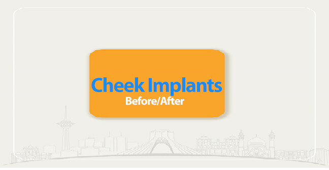 cheek implants before after