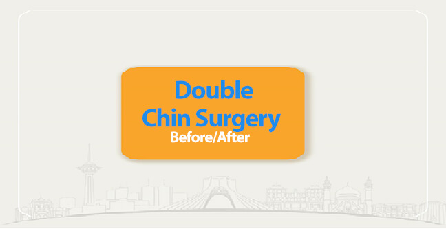 double chin surgery before after