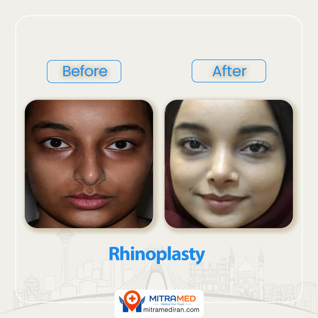 dr nasrin yazdani rhinoplasty before after 72