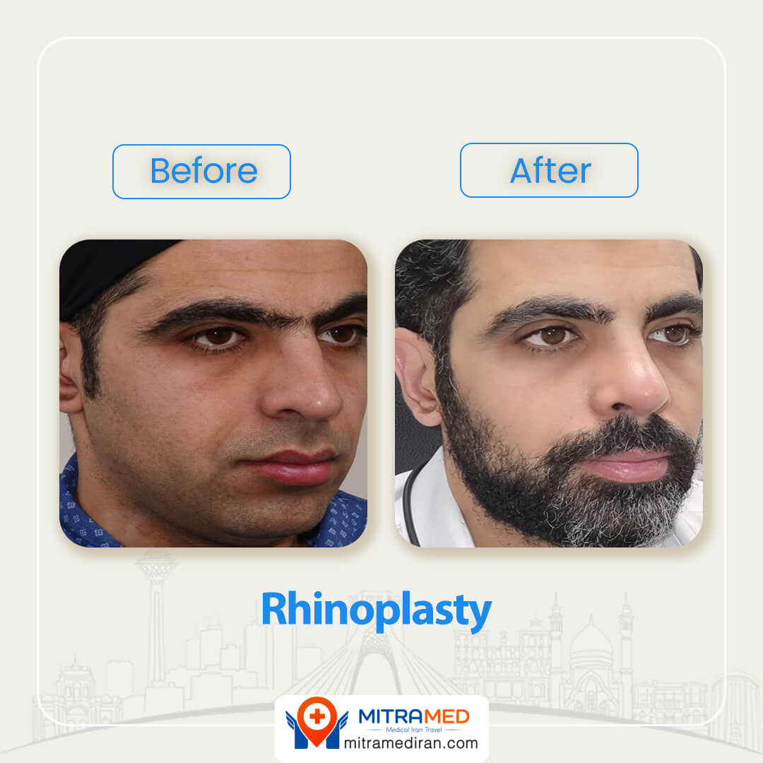 dr nasrin yazdani rhinoplasty before after 74