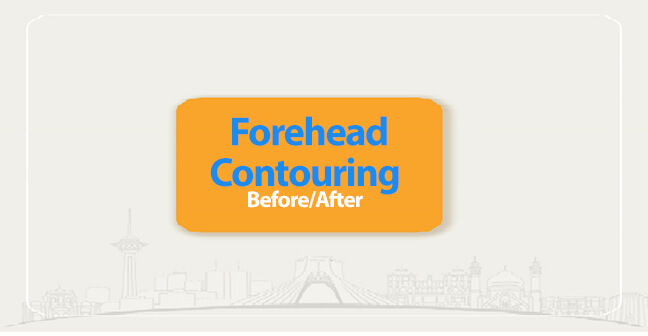 forehead Contouring before after (1)