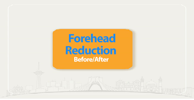 forehead reduction before after
