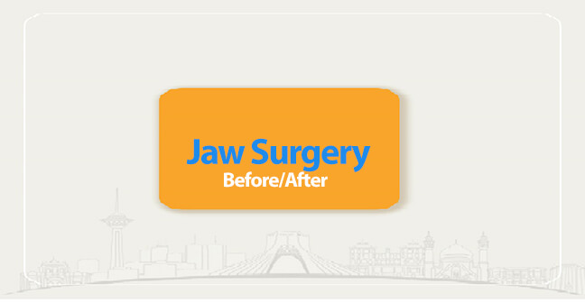 jaw surgery before after
