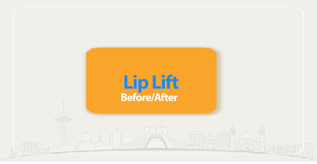 lip lift before after