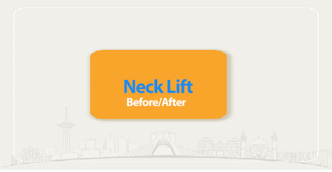 neck Lift before after