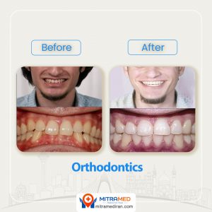 orthodontics before after-1