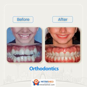 orthodontics in Iran before after-2