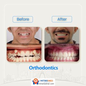 orthodontics in Iran before after-3