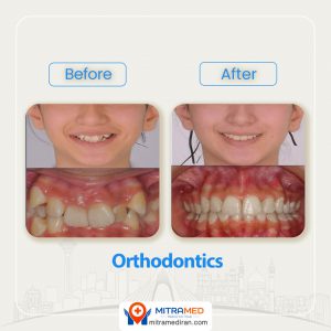 orthodontics before after-4
