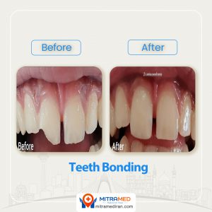 teeth bonding before after-1