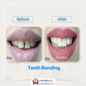 teeth bonding before after-2